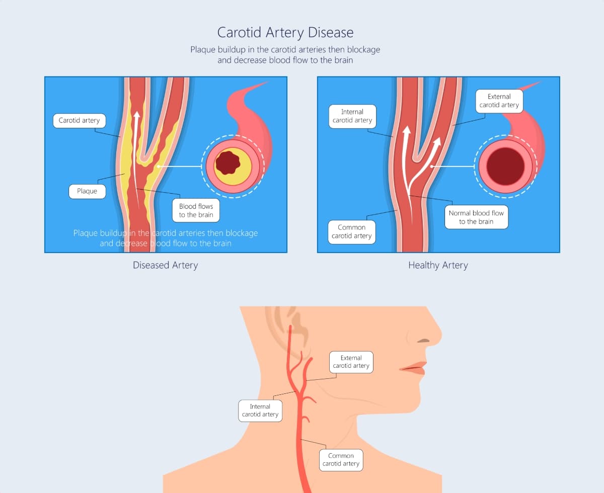 Carotid artery disease - how do I know | Dr Altaf