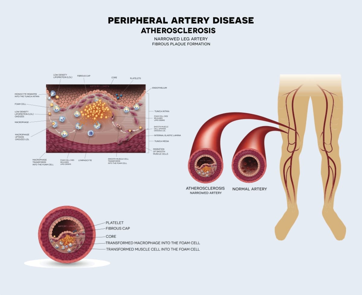 Peripheral artery disease - how do I know | Dr Altaf