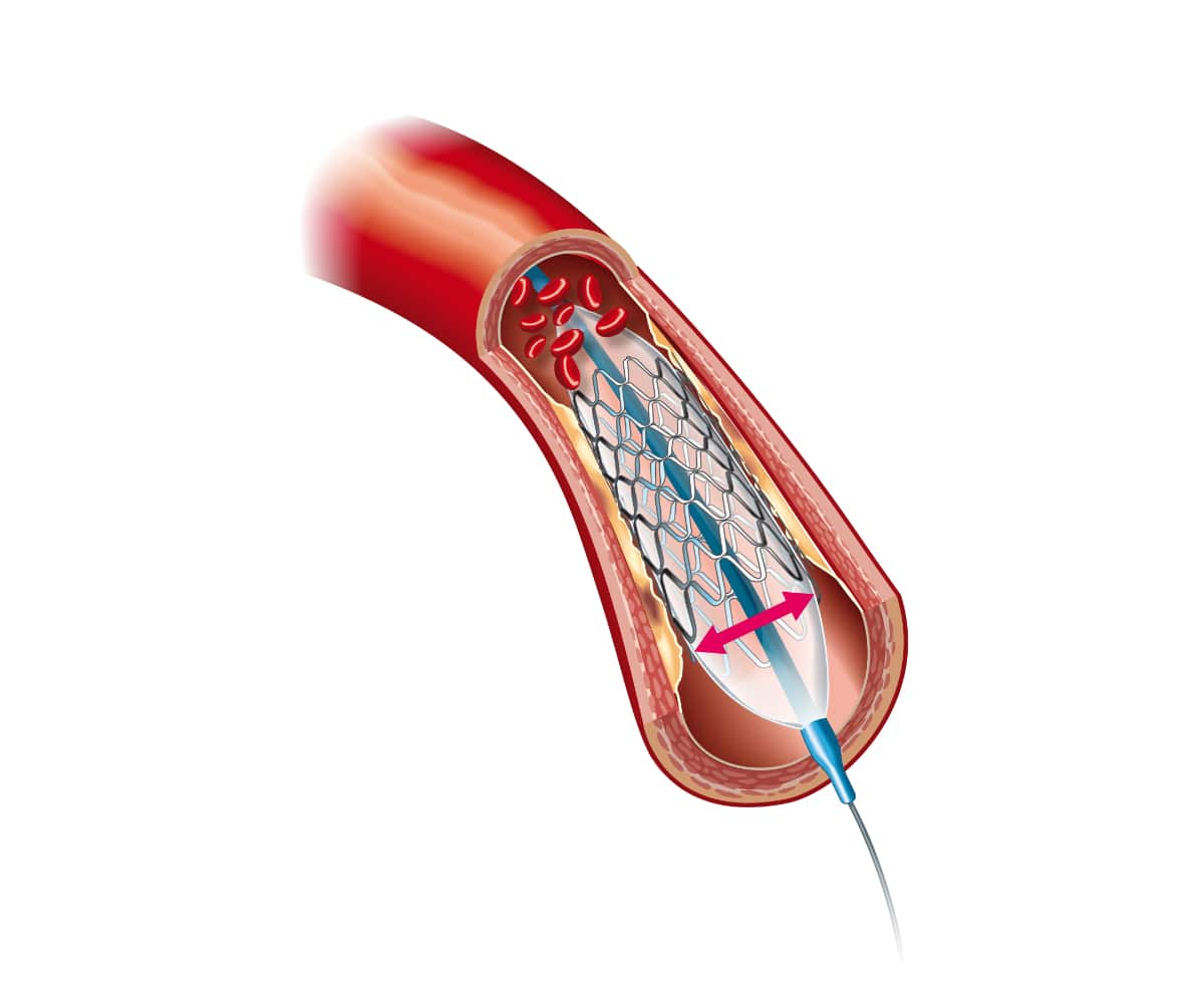 vascular conditions | venous stenting